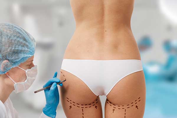 Bikini area Laser Removal